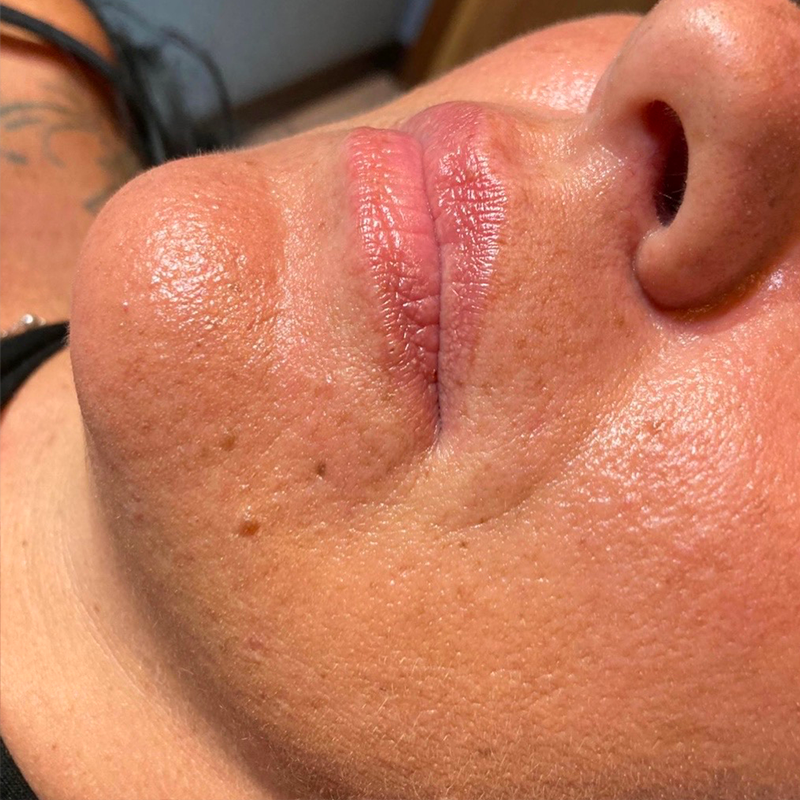 Filler Labbra Prima