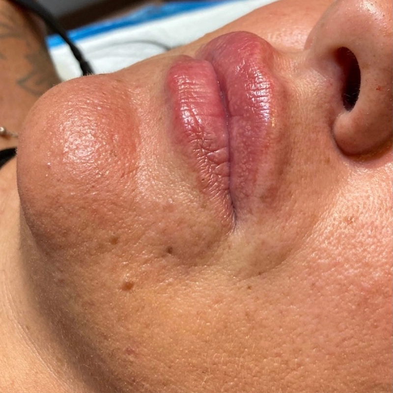 Filler Labbra Dopo