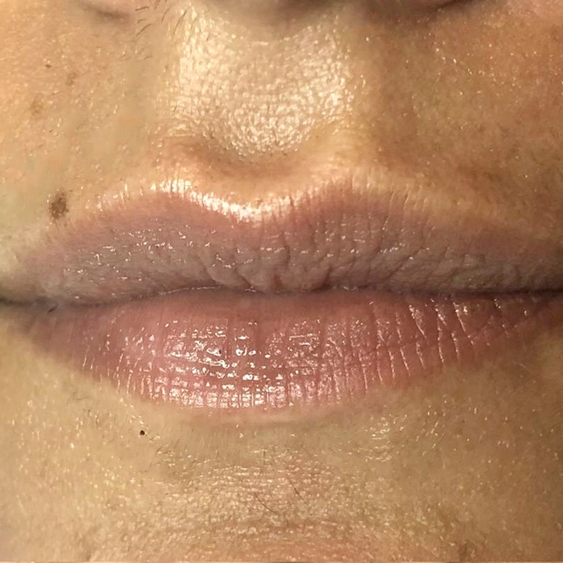 Filler Labbra Prima