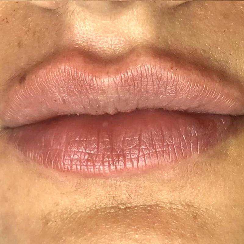 Filler Labbra Dopo